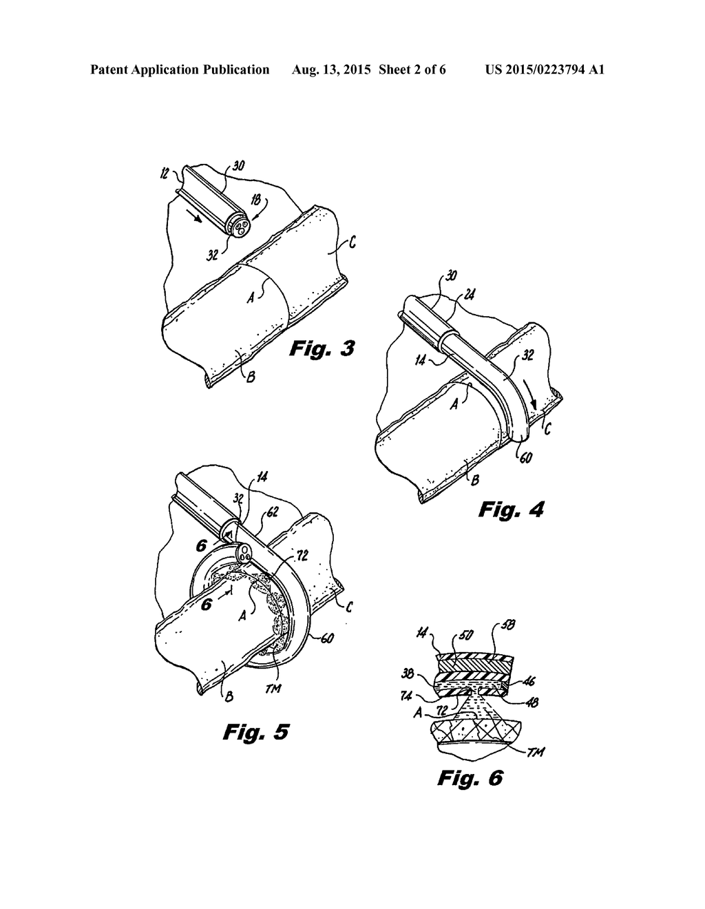 SUPER ELASTIC LOOP EXTRALUMINAL MATERIALS DELIVERY INSTRUMENT - diagram, schematic, and image 03