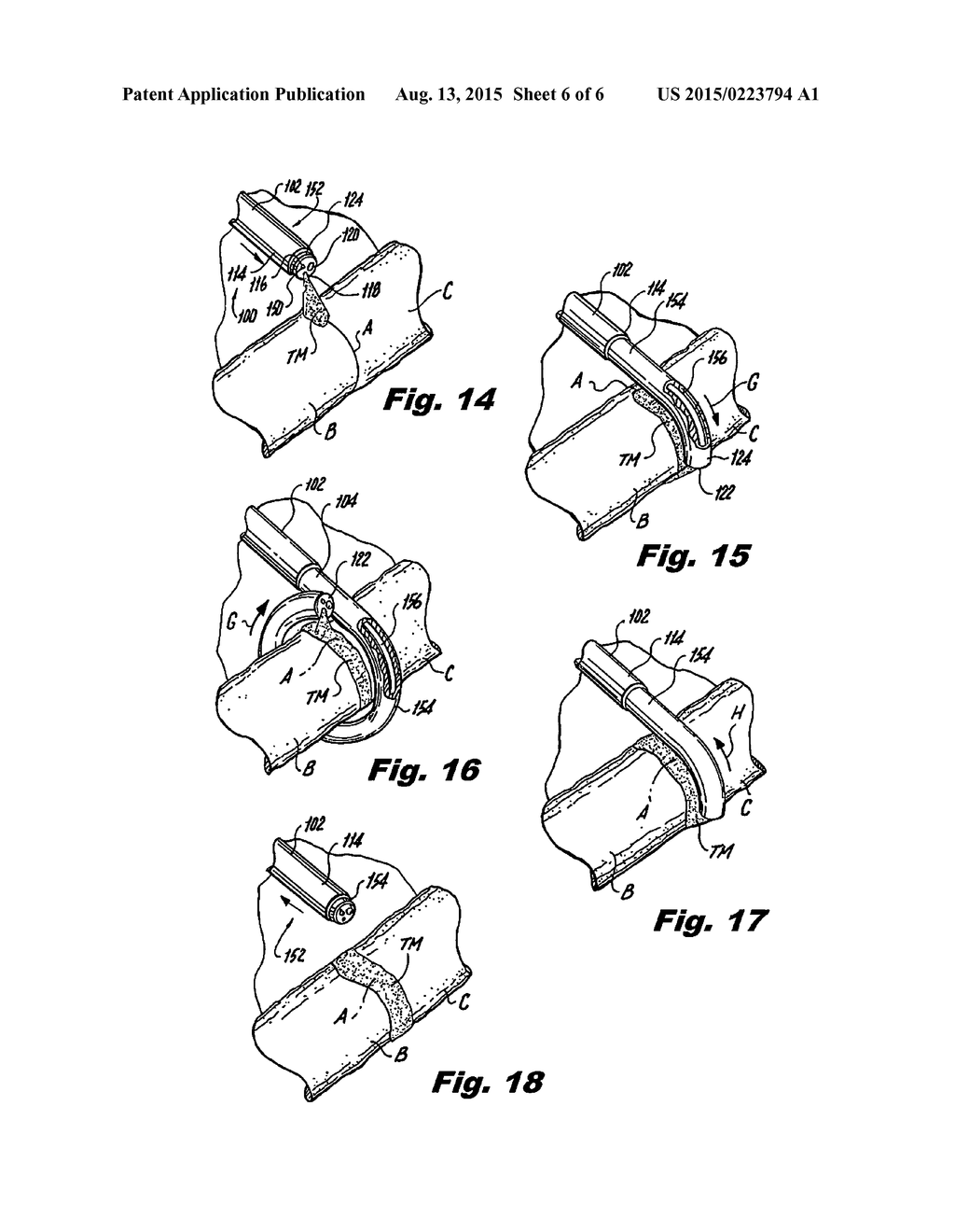 SUPER ELASTIC LOOP EXTRALUMINAL MATERIALS DELIVERY INSTRUMENT - diagram, schematic, and image 07