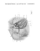 APPARATUS AND METHODS FOR CUTTING AN ATRIAL WALL diagram and image