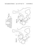 BONE FIXING SYSTEM diagram and image