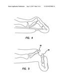 Apparatus and Method for Use in the Treatment of Hammertoe diagram and image