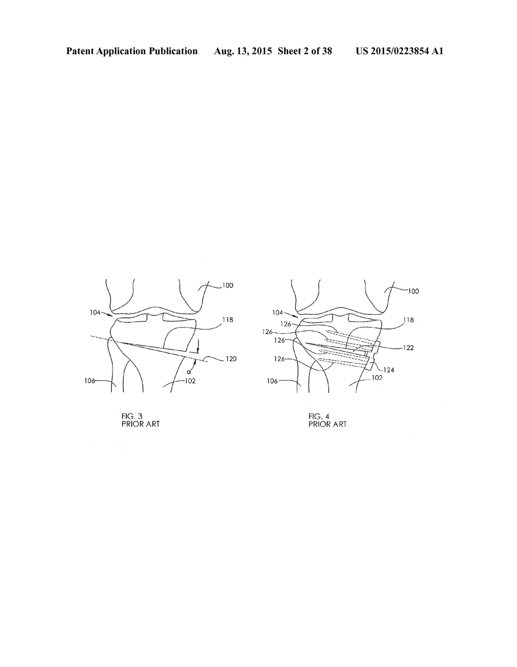ADJUSTABLE DEVICES FOR TREATING ARTHRITIS OF THE KNEE - diagram, schematic, and image 03