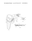 ADJUSTABLE DEVICES FOR TREATING ARTHRITIS OF THE KNEE diagram and image