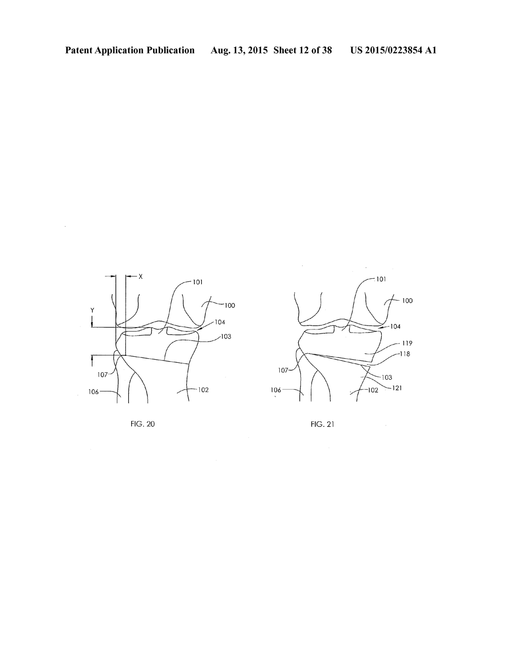 ADJUSTABLE DEVICES FOR TREATING ARTHRITIS OF THE KNEE - diagram, schematic, and image 13