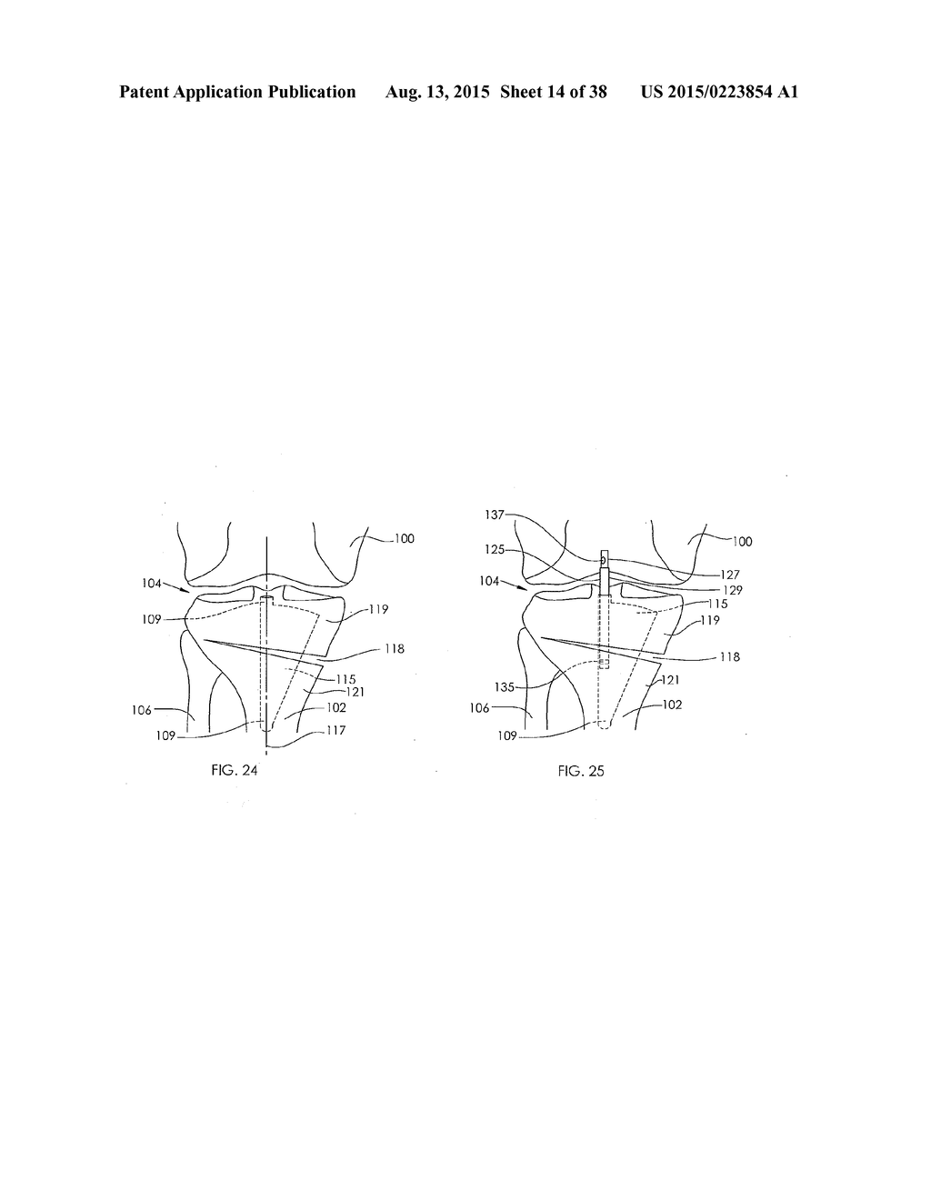 ADJUSTABLE DEVICES FOR TREATING ARTHRITIS OF THE KNEE - diagram, schematic, and image 15