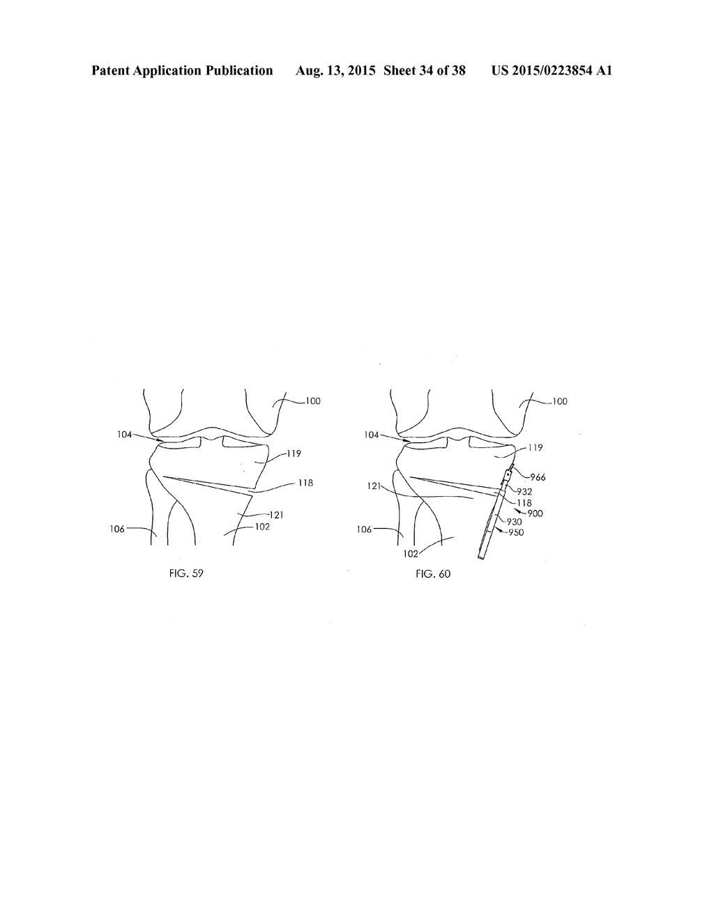 ADJUSTABLE DEVICES FOR TREATING ARTHRITIS OF THE KNEE - diagram, schematic, and image 35