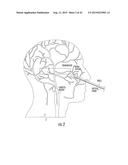 METHOD AND SYSTEM FOR TRANSCRANIAL PHOTOACOUSTIC IMAGING FOR GUIDING SKULL     BASE SURGERIES diagram and image