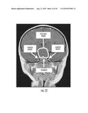 METHOD AND SYSTEM FOR TRANSCRANIAL PHOTOACOUSTIC IMAGING FOR GUIDING SKULL     BASE SURGERIES diagram and image