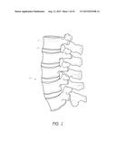 ARTIFICIAL DISC diagram and image