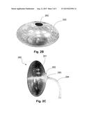 ANCHORED NON-SPHERICAL BALLOON FOR THE TREATMENT OF OBESITY diagram and image