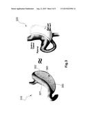 ANCHORED NON-SPHERICAL BALLOON FOR THE TREATMENT OF OBESITY diagram and image