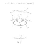 COMBINED TREATMENT FOR CATARACT AND GLAUCOMA TREATMENT diagram and image