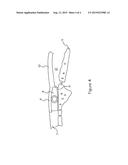 Internal Shunt And Method For Treating Glaucoma diagram and image