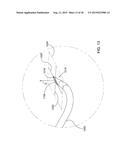 METHODS AND APPARATUS FOR DELIVERING OCULAR IMPLANTS  INTO THE EYE diagram and image