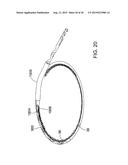 METHODS AND APPARATUS FOR DELIVERING OCULAR IMPLANTS  INTO THE EYE diagram and image