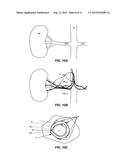 Treatment of Renal Hypertension or Carotid Sinus Syndrome with Adventitial     Pharmaceutical Sympathetic Denervation or Neuromodulation diagram and image