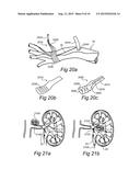 ENDOSCOPIC SYMPATHECTOMY SYSTEMS AND METHODS diagram and image