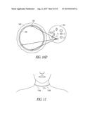 METHOD AND APPARATUS FOR SELECTIVE NERVE STIMULATION diagram and image