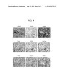 MULTIPLEXED METHOD FOR DIAGNOSING CLASSICAL HODGKIN LYMPHOMA diagram and image