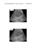 Twinkle artifact suppression in ultrasound color flow diagram and image