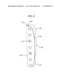 Universal Bioabsorbable Nasal Implant Kit diagram and image