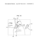 Universal Bioabsorbable Nasal Implant Kit diagram and image