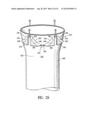 ENDOVASCULAR GRAFT JOINT AND METHOD FOR MANUFACTURE diagram and image