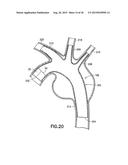 STENT/GRAFT ASSEMBLY diagram and image