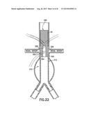 STENT/GRAFT ASSEMBLY diagram and image