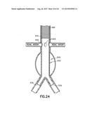 STENT/GRAFT ASSEMBLY diagram and image