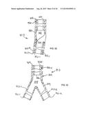 STENT/GRAFT ASSEMBLY diagram and image