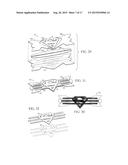 Nasal Dilator with Decorative Design Element diagram and image