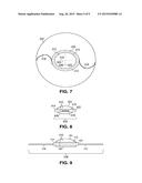 INTRAOCULAR LENS diagram and image