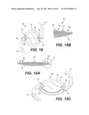 MODULAR INTRAOCULAR LENS DESIGNS, TOOLS AND METHODS diagram and image