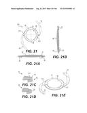 MODULAR INTRAOCULAR LENS DESIGNS, TOOLS AND METHODS diagram and image