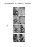 ISOLATION AND CO-TRANSPLANTAION OF BONE MARROW MESENCHYMAL STEM CELLS WITH     CD34+ HEMATOPOIETIC STEM/PROGENITOR CELLS diagram and image