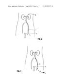 APPARATUS FOR DELIVERING FLUID TO TREAT RENAL HYPERTENSION diagram and image