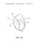 INTRAVASCULAR CATHETERS, SYSTEMS, AND METHODS diagram and image