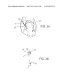 INTRAVASCULAR CATHETERS, SYSTEMS, AND METHODS diagram and image