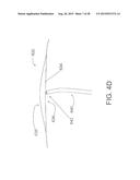 INTRAVASCULAR CATHETERS, SYSTEMS, AND METHODS diagram and image