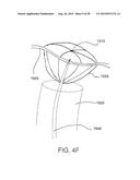 INTRAVASCULAR CATHETERS, SYSTEMS, AND METHODS diagram and image