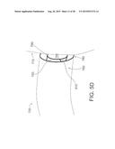 INTRAVASCULAR CATHETERS, SYSTEMS, AND METHODS diagram and image