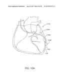 INTRAVASCULAR CATHETERS, SYSTEMS, AND METHODS diagram and image