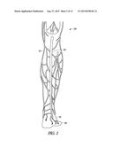 ELONGATE EXPANDABLE MEMBER FOR OCCLUDING VASCULAR VESSEL diagram and image