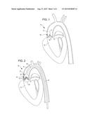 SHOCKWAVE VALVULOPLASTY CATHETER SYSTEM diagram and image