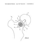 Implant Fixation Device diagram and image