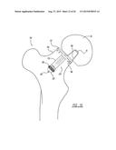 Implant Fixation Device diagram and image