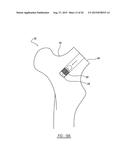 Implant Fixation Device diagram and image