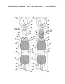 Implant Fixation Device diagram and image