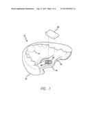 DENTAL SLEEP APPLIANCE diagram and image